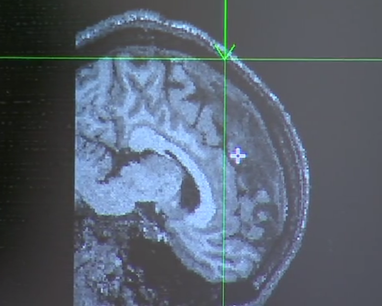 El ARN mensajero «mira» también a las enfermedades del cerebro