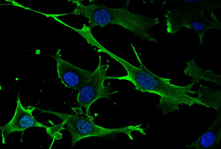 Descubierto un nuevo gen inductor de cáncer y sus debilidades terapéuticas