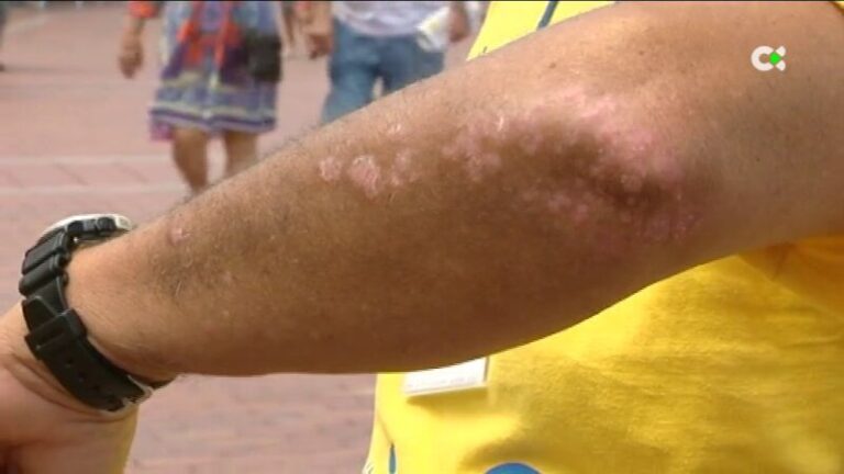 Nuevo medicamento para los pacientes con psoriasis