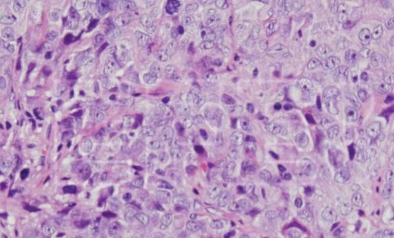 Hallan una vía molecular implicada en el cáncer de ovario y en su resistencia