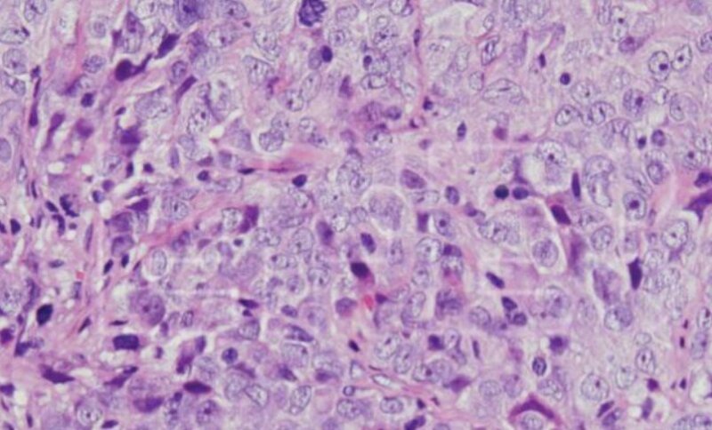 Hallan una vía molecular implicada en el cáncer de ovario y en su resistencia