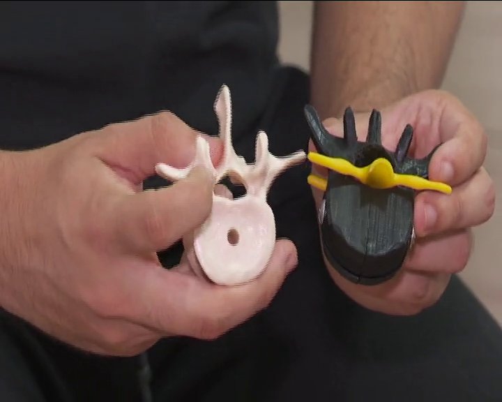 Una nueva prótesis podría evitar determinadas lesiones a causa de la osteoporosis