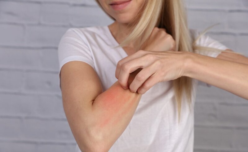 Dermatitis atópica grave.