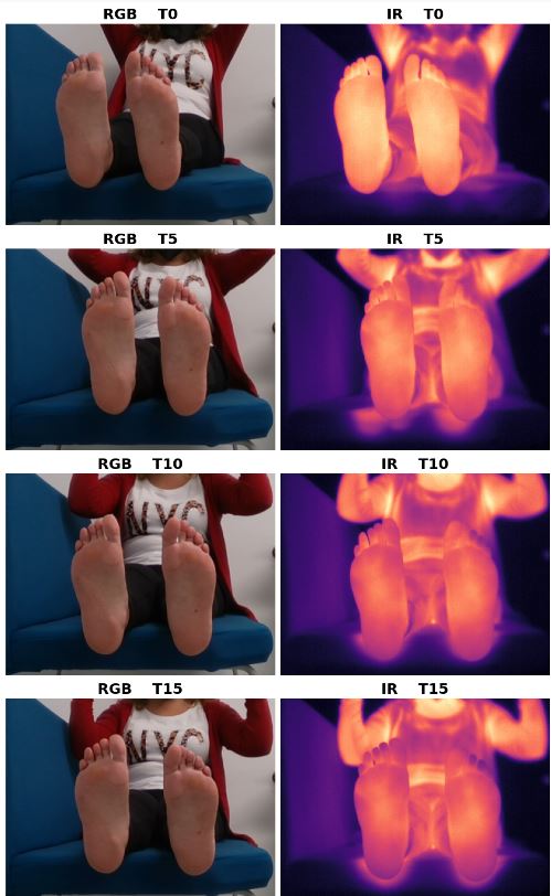 Ejemplos del estudio sobre el pie diabético/IAC