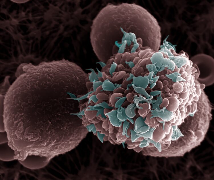 Un estudio demuestra que bloqueando la molécula ENPP1 se potencia la radioterapia y acaba con la recaída del cáncer de mama triple negativo 