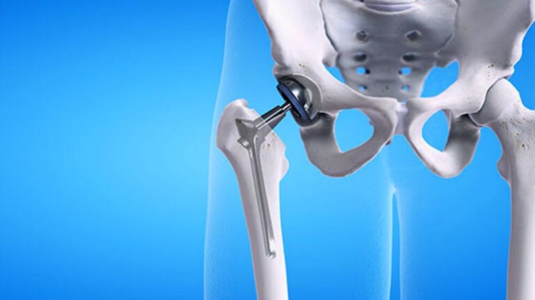 Afectados en Canarias por las prótesis defectuosas de Johnson & Johnson