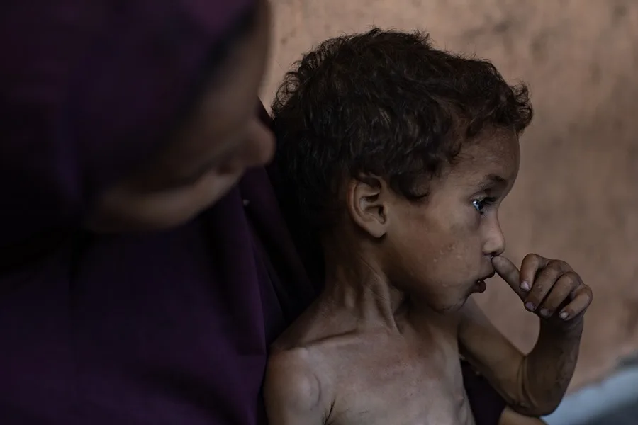 Cinco gazatíes murieron por desnutrición este lunes, dos de ellos niños