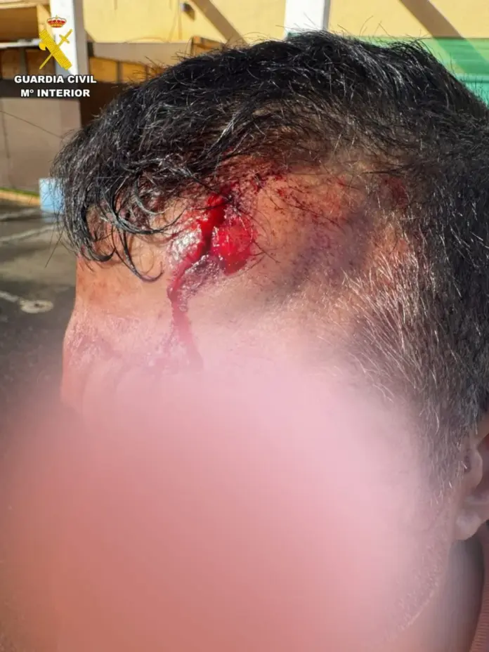 Herida de 15 centímetros que sufrió un hombre al ser apuñalado en Corralejo