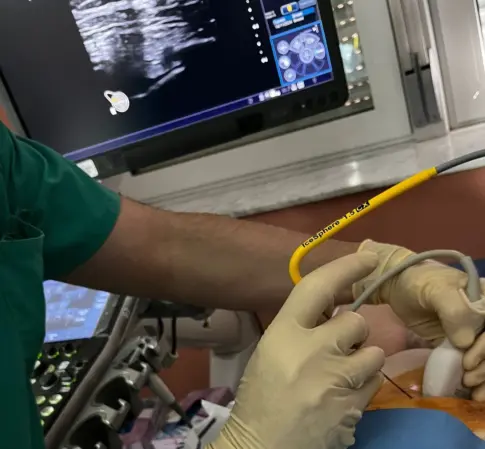 El Hospital La Candelaria aplica una técnica novedosa de crioablación en doce pacientes con cáncer de mama