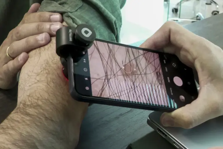 El cáncer de piel en Tenerife sube un 40% en 4 años